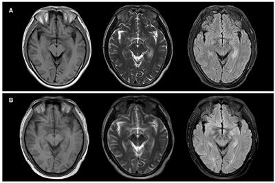 The First Case of Familiar Anti-leucine-rich Glioma-Inactivated1 Autoimmune Encephalitis: A Case Report and Literature Review